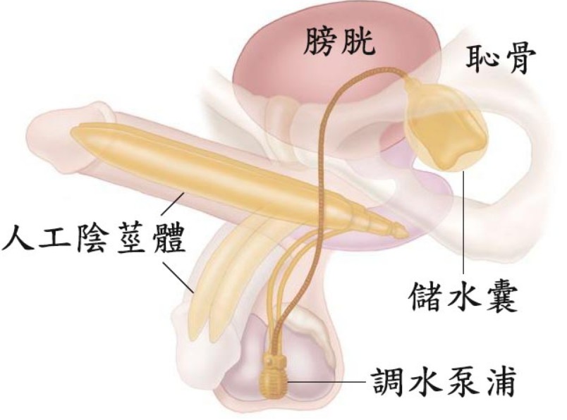 人工陰莖植入術